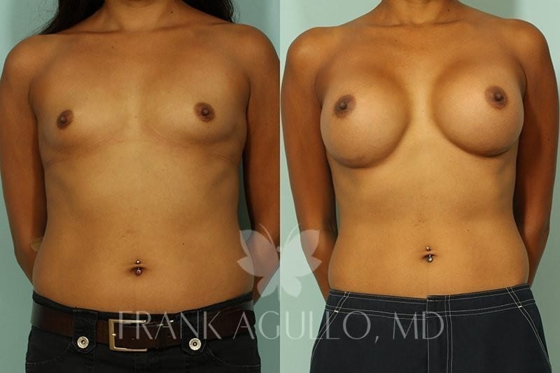 Breast Before and After 3