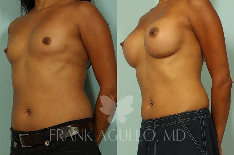 Breast Augmentation Before and After 2