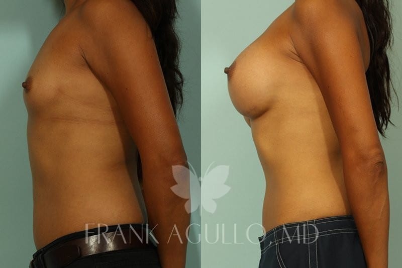 Breast Augmentation Before and After 3
