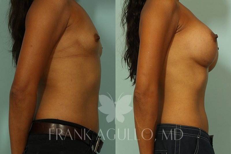 Breast Augmentation Before and After 4