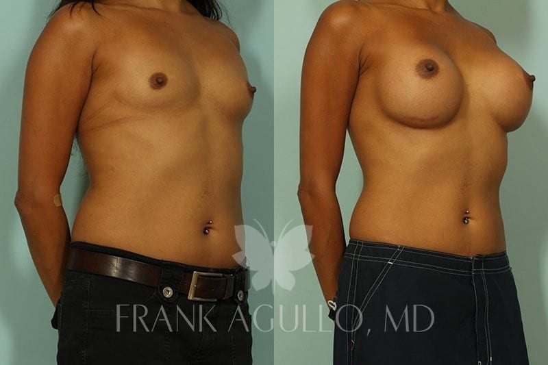 Breast Augmentation Before and After 5