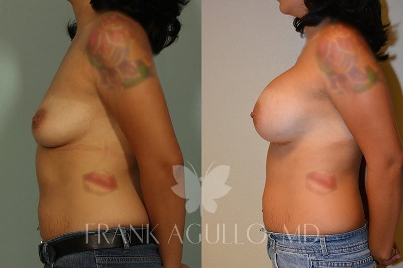 Breast Augmentation Before and After 2