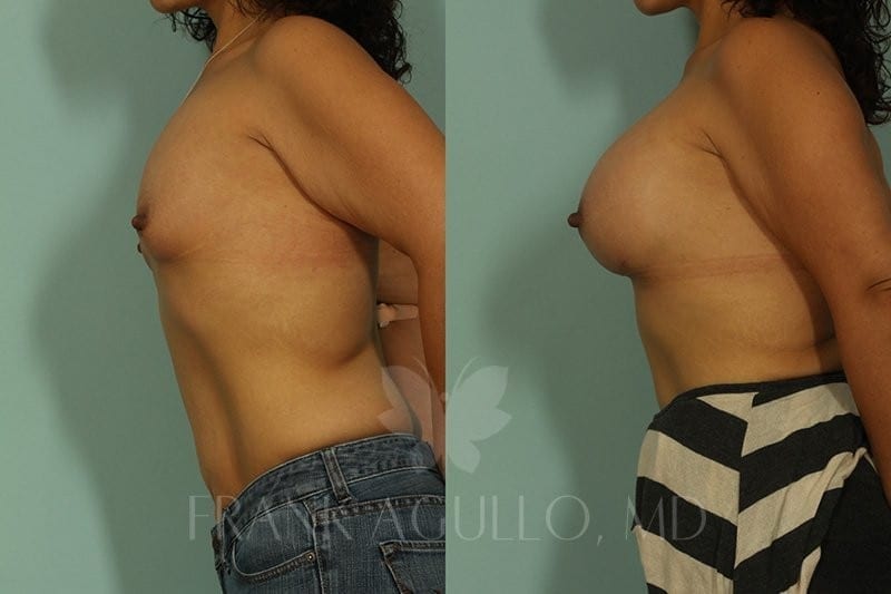 Breast Augmentation Before and After 8