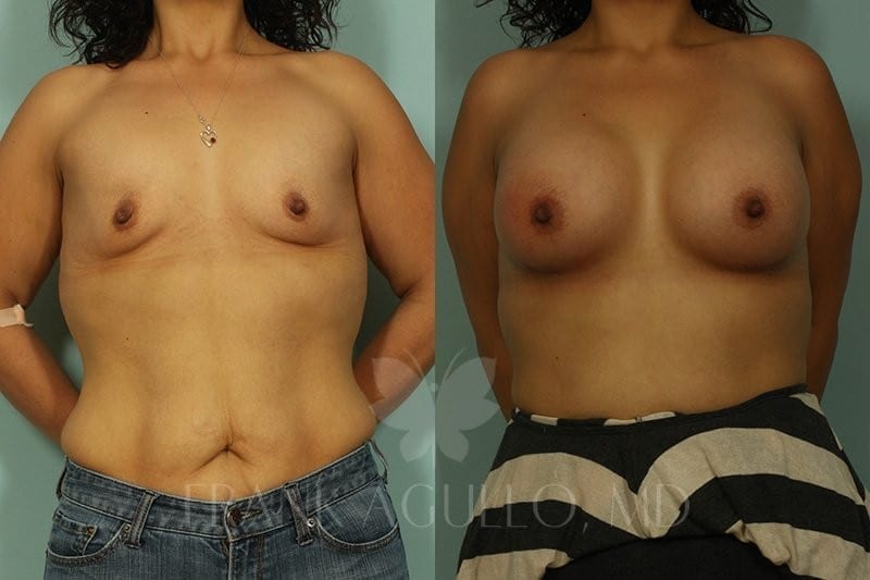Breast Augmentation Before and After 3