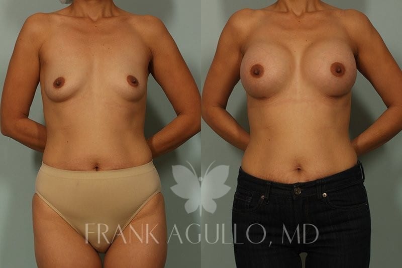 Breast Augmentation Before and After 10