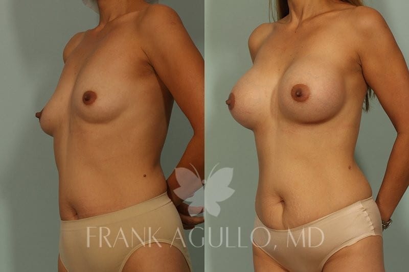 Breast Augmentation Before and After 8