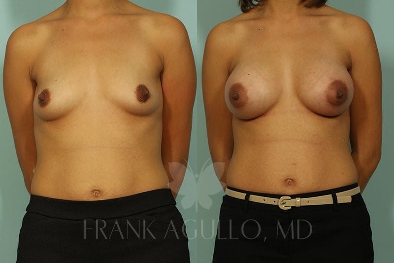 Breast Augmentation Before and After 2