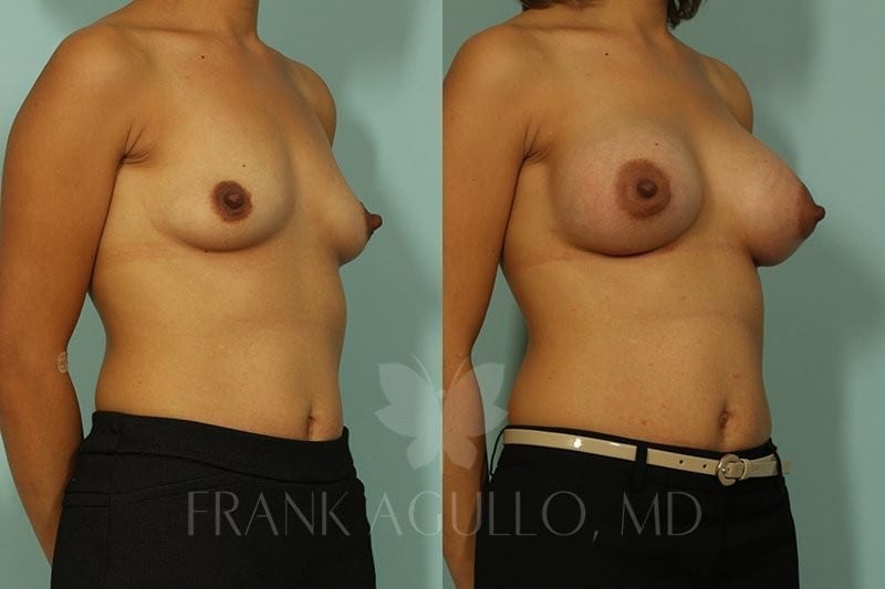 Breast Augmentation Before and After 3