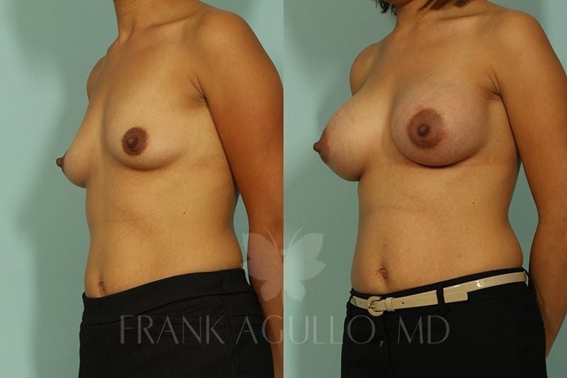 Breast Augmentation Before and After 4