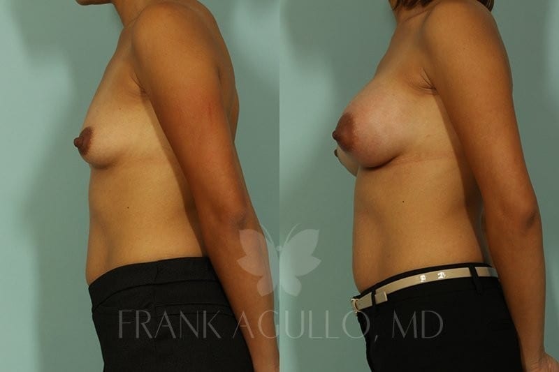Breast Augmentation Before and After 5