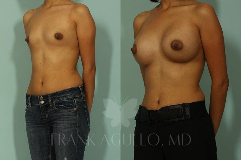 Breast Augmentation Before and After 6