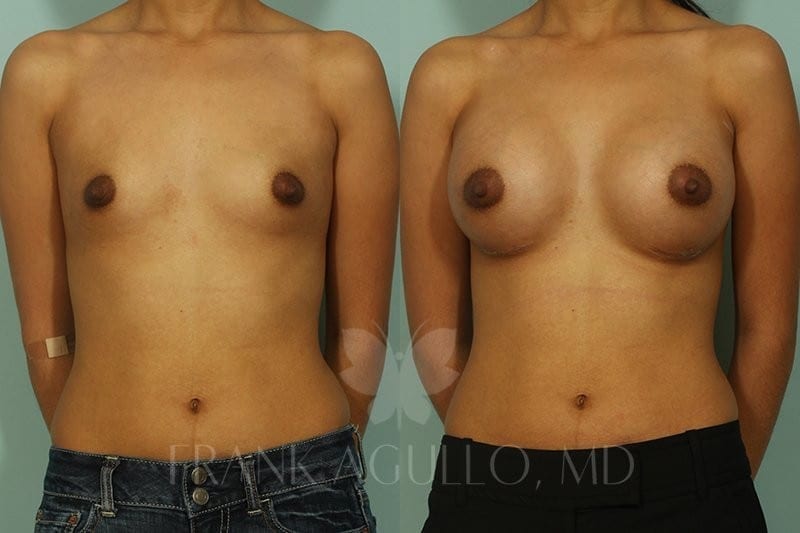 Breast Augmentation Before and After 5