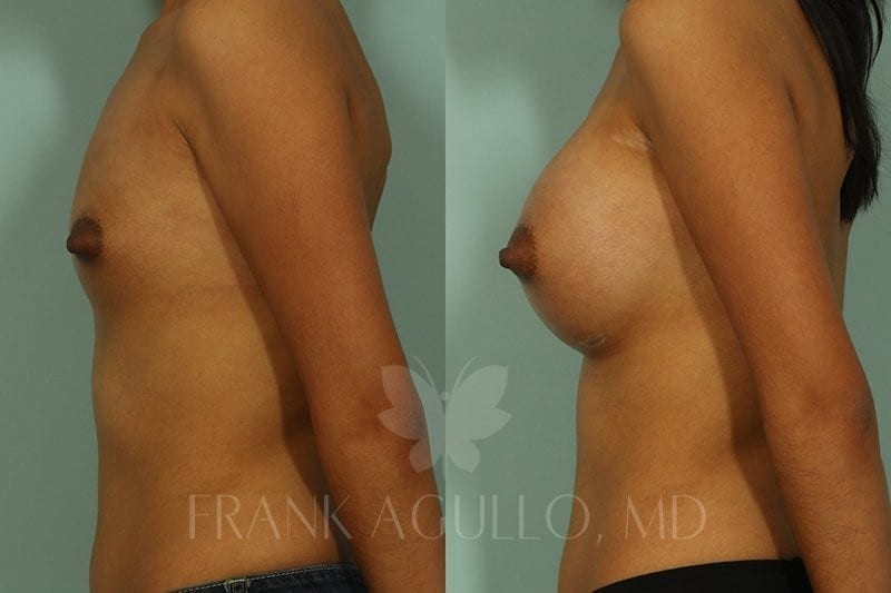 Breast Augmentation Before and After 3