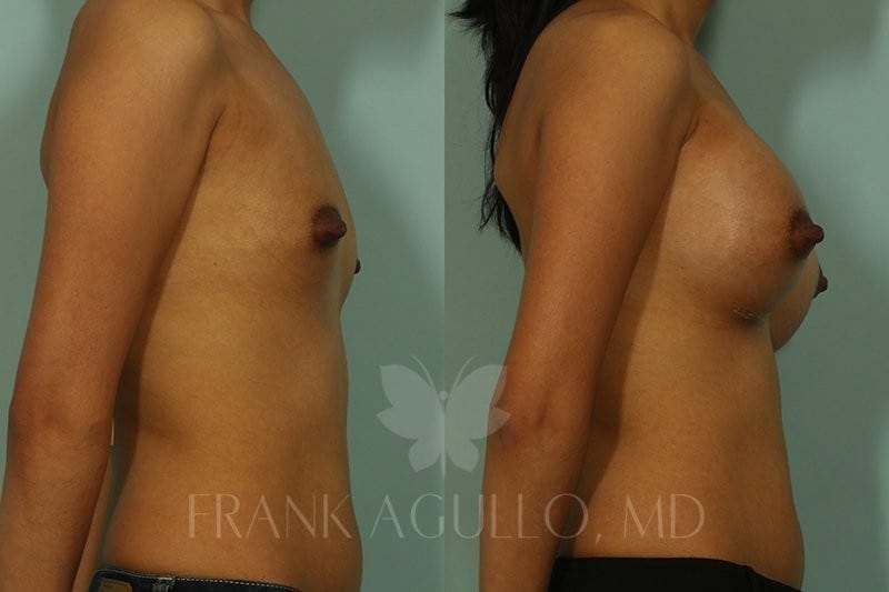 Breast Augmentation Before and After 2