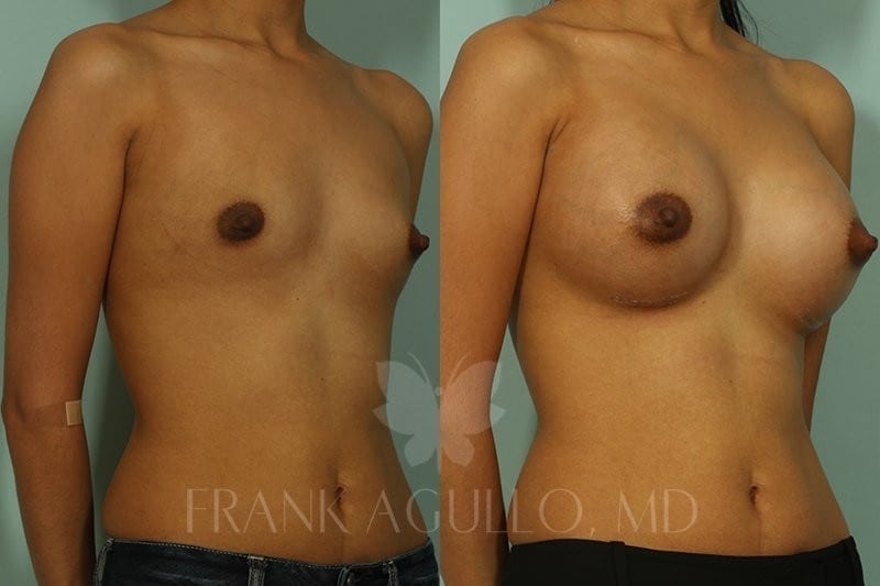 Breast Before and After 19