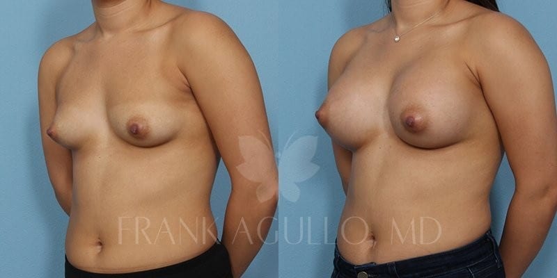 Breast Before and After 18