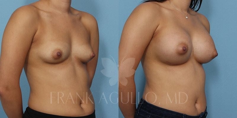 Breast Augmentation Before and After 3