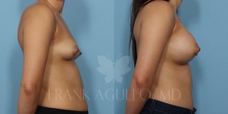 Breast Augmentation Before and After 4