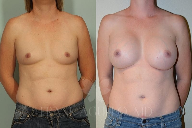 Breast Before and After 17