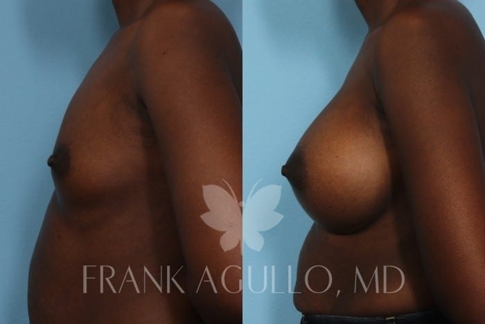 Breast Augmentation Before and After 2