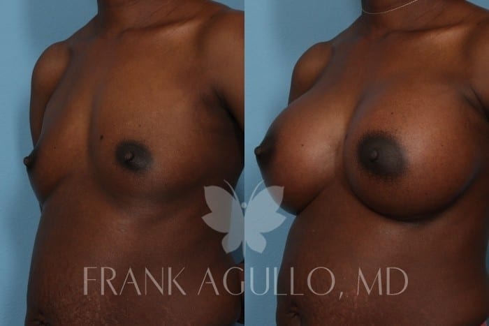 Breast Augmentation Before and After 3