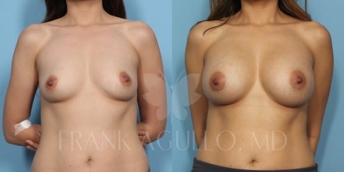 Breast Augmentation Before and After 3