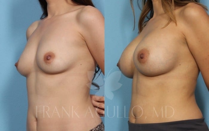 Breast Augmentation Before and After 2