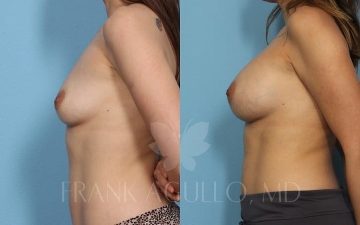 Breast Augmentation Before and After 4