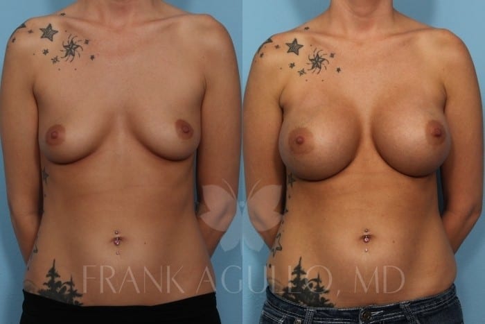 Breast Augmentation Before and After 3