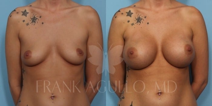 Breast Augmentation Before and After 2