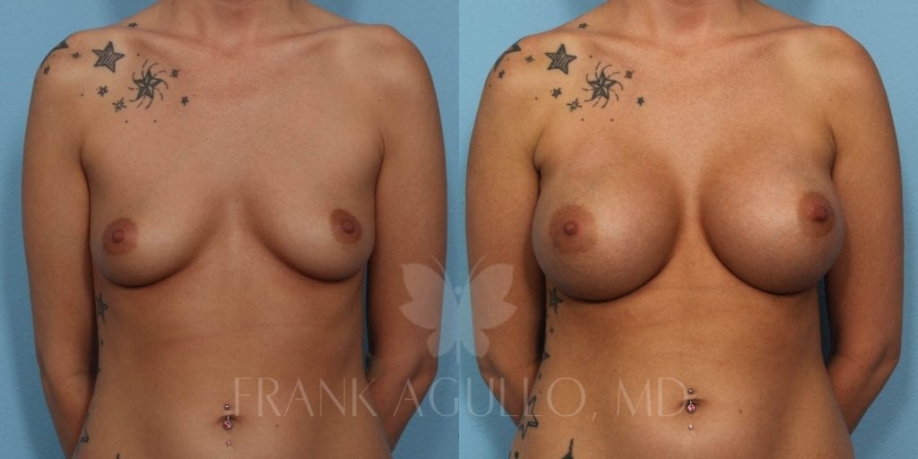 Breast Augmentation Before and After 3