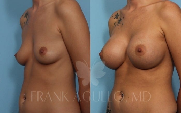 Breast Augmentation Before and After 4