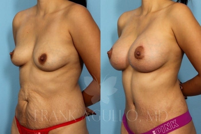 Breast Augmentation Before and After 2