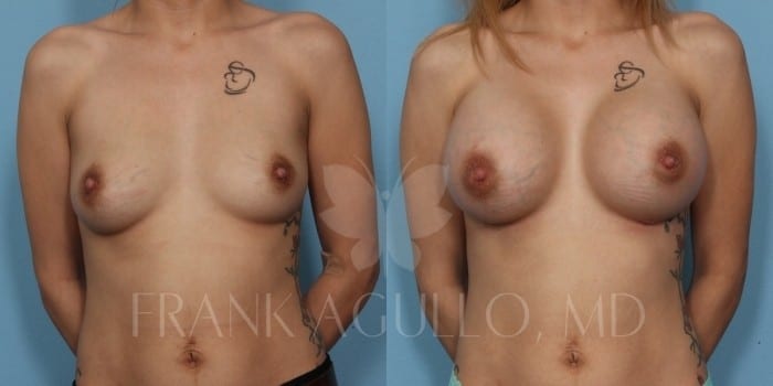 Breast Augmentation Before and After 5