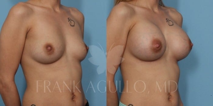 Breast Augmentation Before and After 2