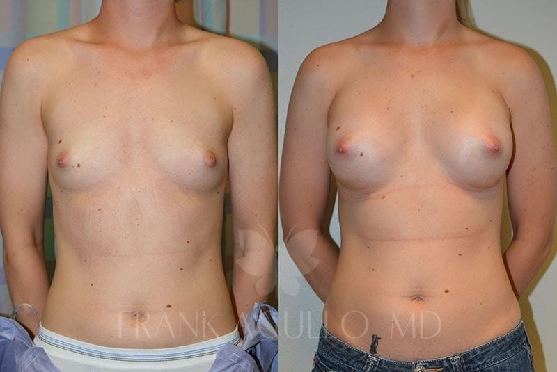 Breast Augmentation Before and After 5