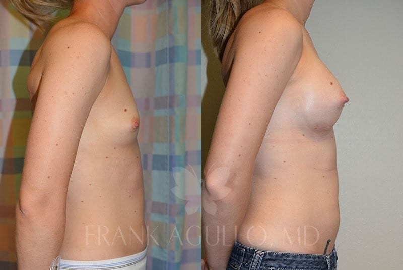 Breast Augmentation Before and After 2