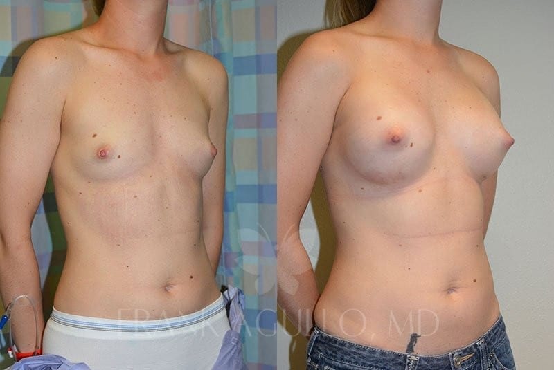 Breast Augmentation Before and After 3