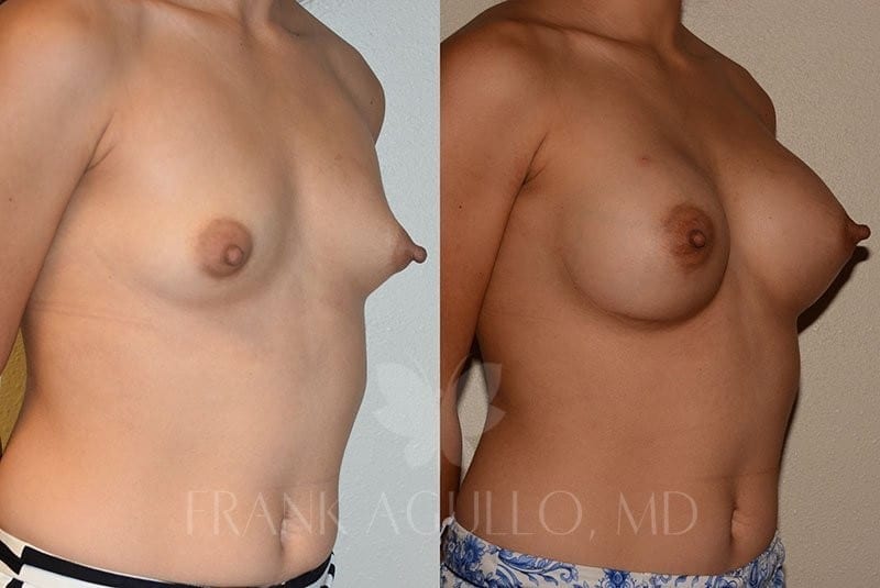 Breast Augmentation Before and After 2