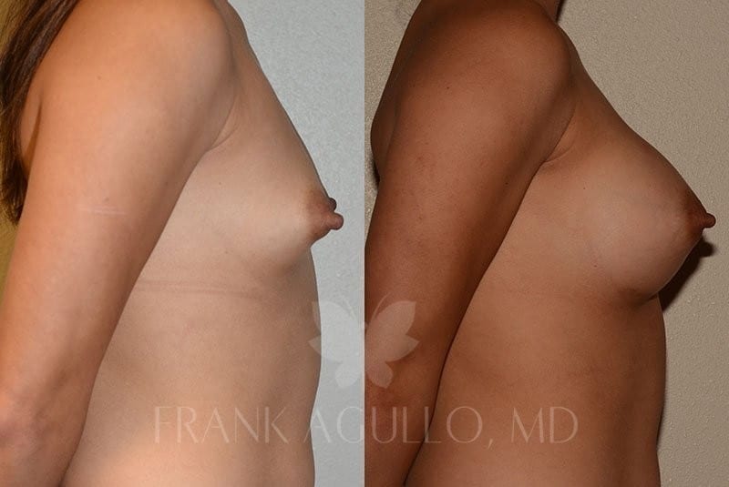 Breast Augmentation Before and After 3