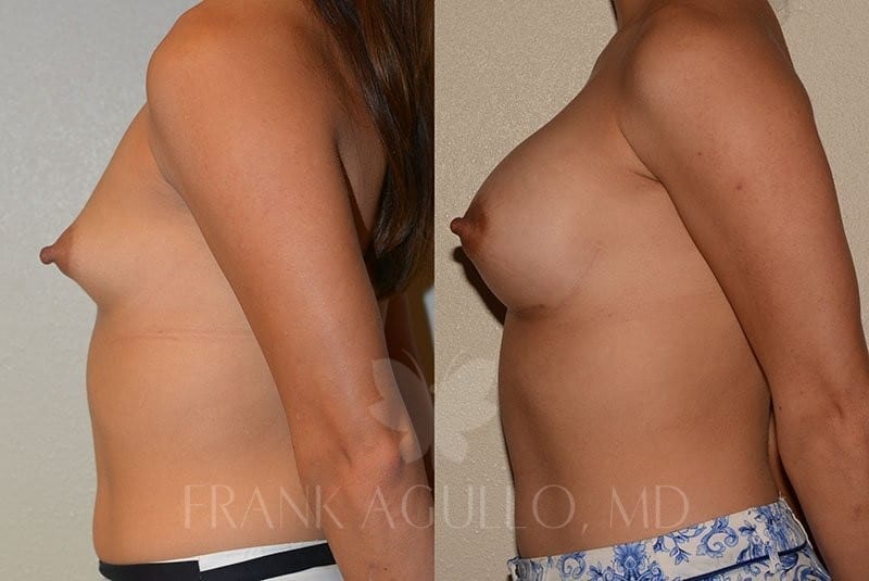 Breast Augmentation Before and After 5