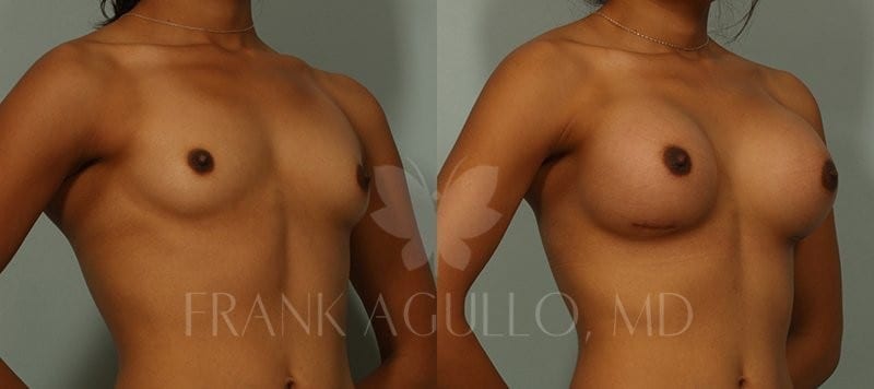 Breast Augmentation Before and After 2