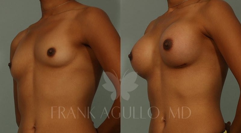 Breast Augmentation Before and After 4