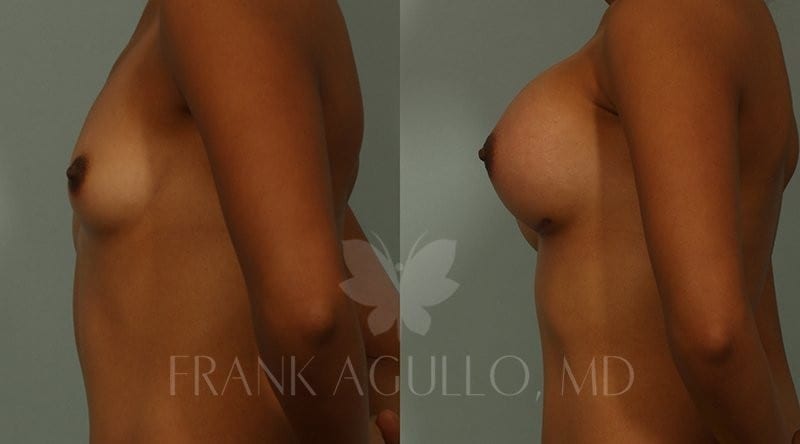 Breast Augmentation Before and After 5