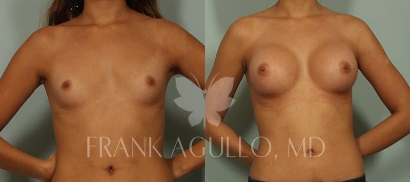 Breast Augmentation Before and After 2