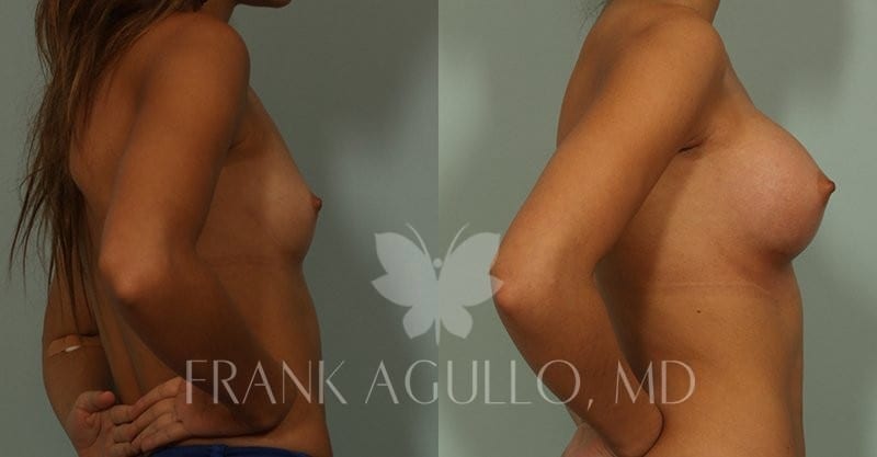 Breast Augmentation Before and After 3