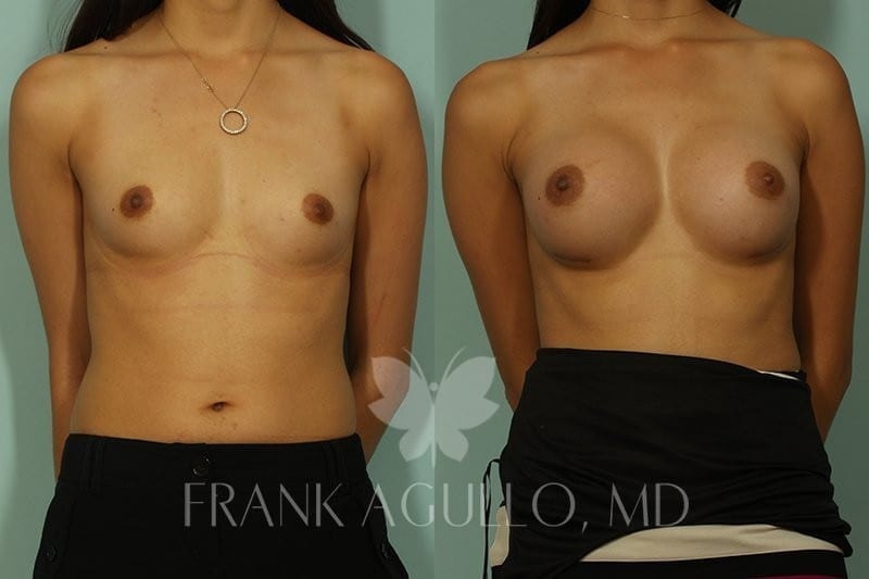 Breast Augmentation Before and After 5