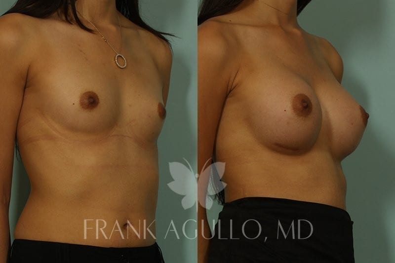 Breast Augmentation Before and After 4