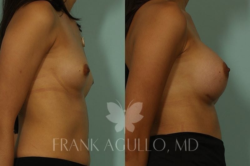 Breast Augmentation Before and After 3