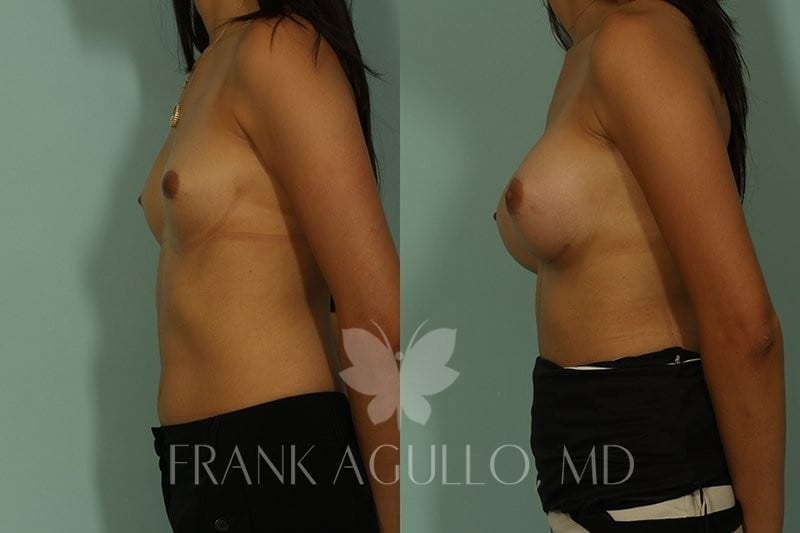 Breast Augmentation Before and After 2